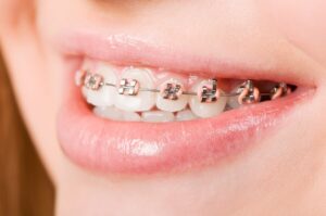 an example of the types of braces for teeth