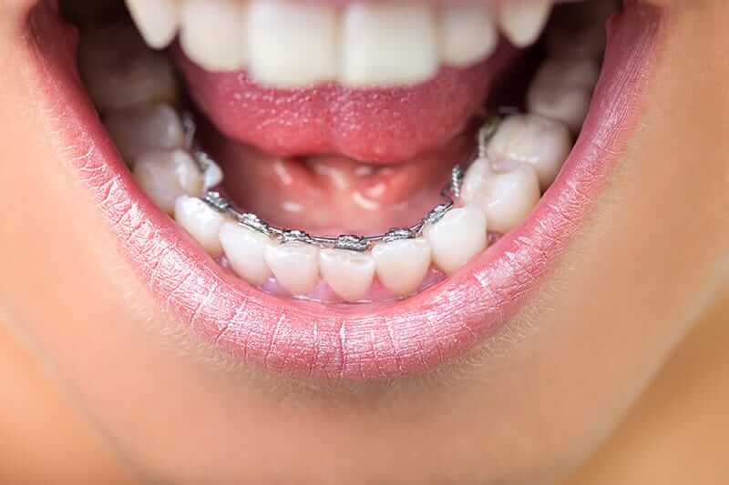 patient wearing lingual braces