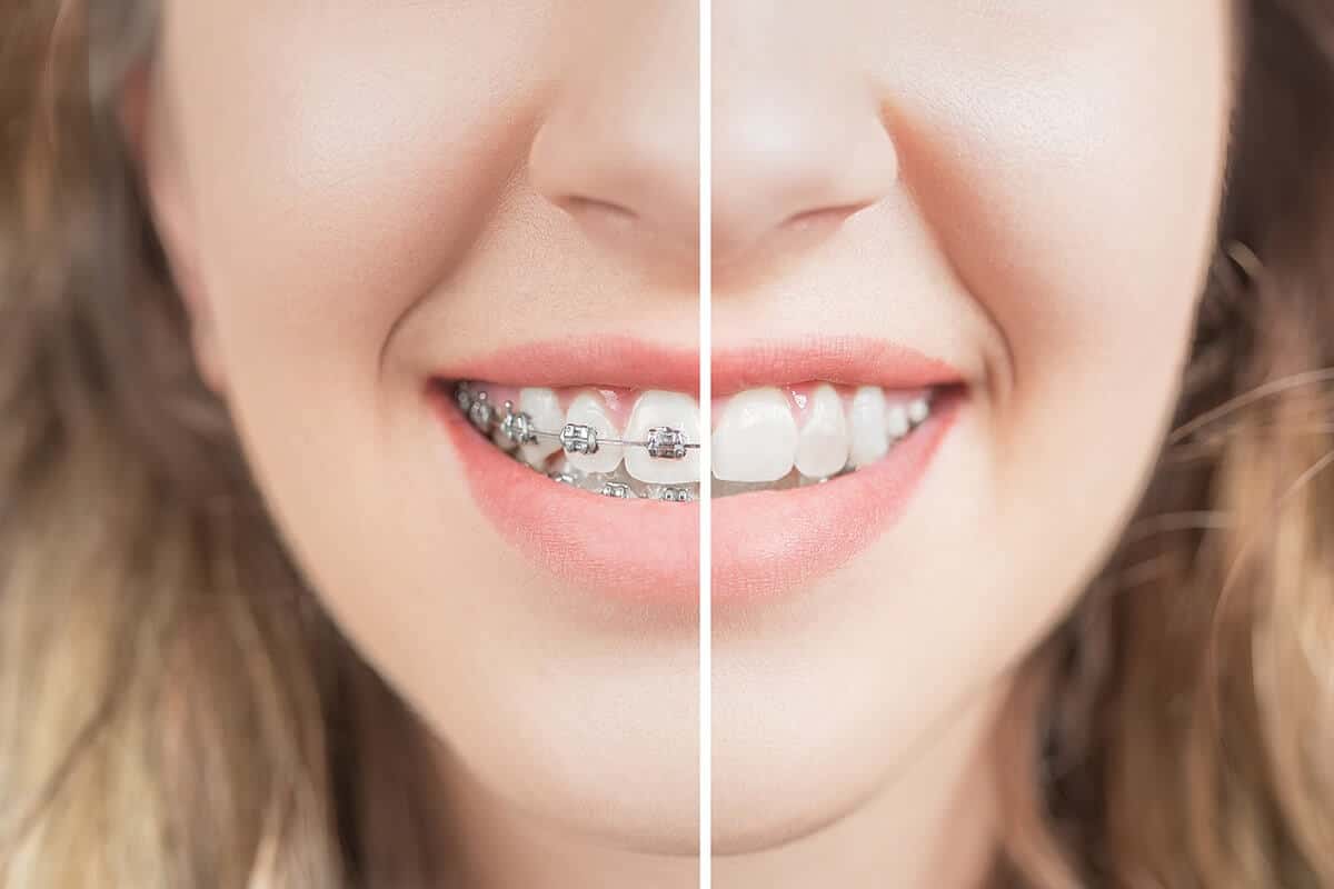 young girl smiling before and after braces
