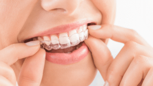 How to Straighten Teeth Without Braces?