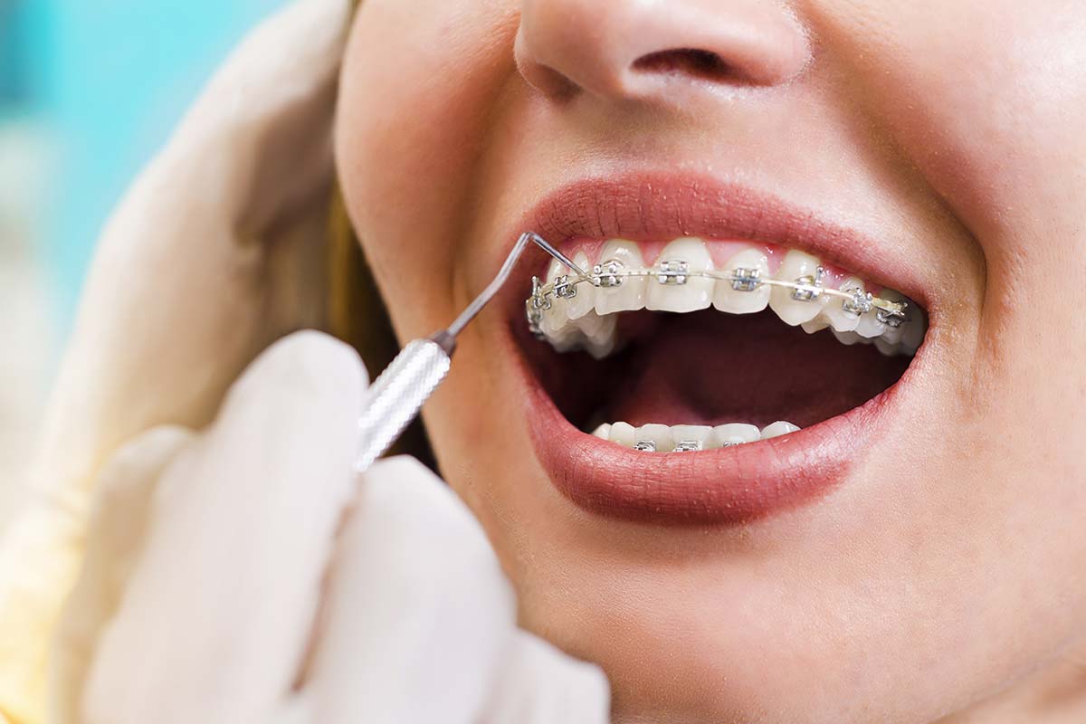 woman getting braces and receding gums checked by orthodontist