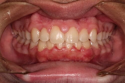 After Treatment Teeth