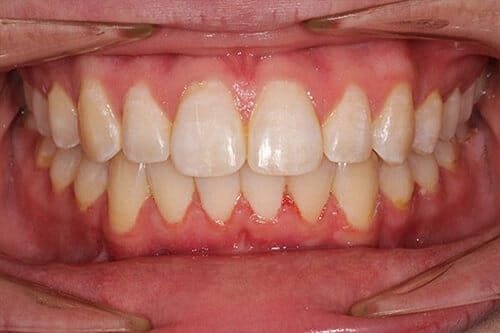 Teeth Treatment After