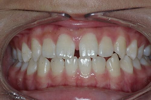 Gap in Teeth