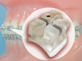 Bracket in Ricci Orthodontics