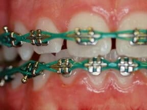 Ricci Orthodontics Chain
