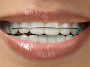Removable Retainer in Johns Creek