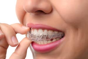 Close up of a woman inserting an Invisalign clear aligner