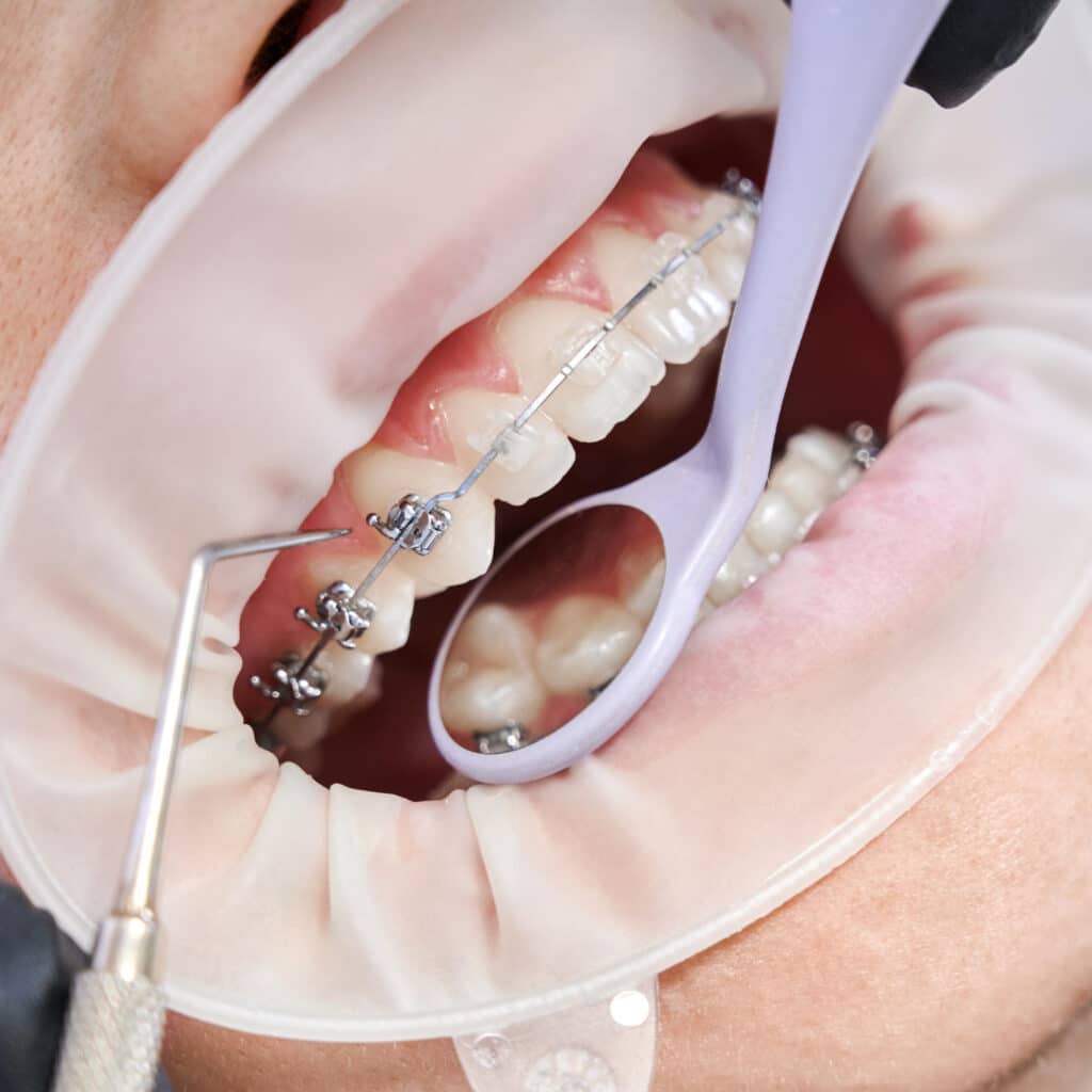 Does Insurance Cover Braces? 5 Important Facts