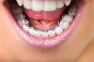 Information-About-Lingual-Braces Information About Lingual Braces