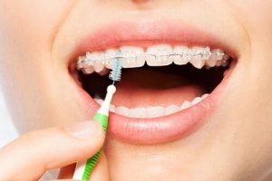 Oral-Healthcare-In-Review-Proper-Cleanings-For-Braces Oral Healthcare In Review Proper Cleanings For Braces