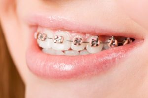 There-are-Different-Variations-of-Braces-to-Help-Correct-the-Alignment-of-Your-Teeth-768x510 There are Different Variations of Braces to Help Correct the Alignment of Your Teeth 768x510