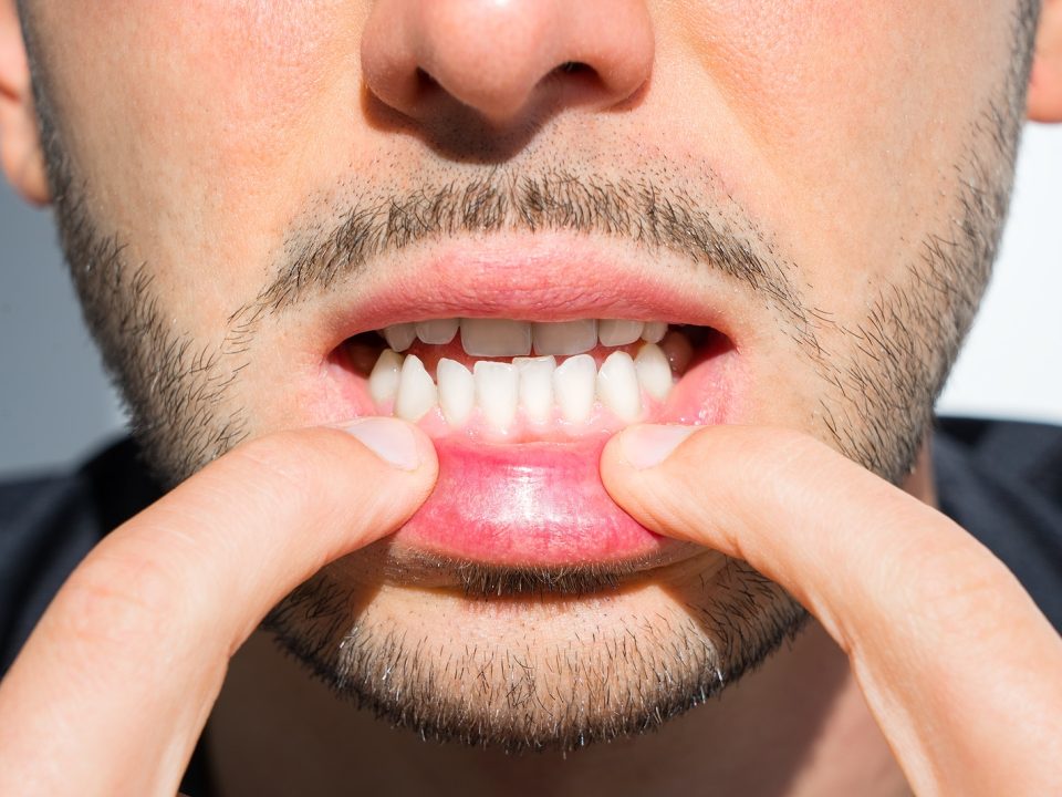 bigstock Young Man Crooked Teeth Reaso 403620719