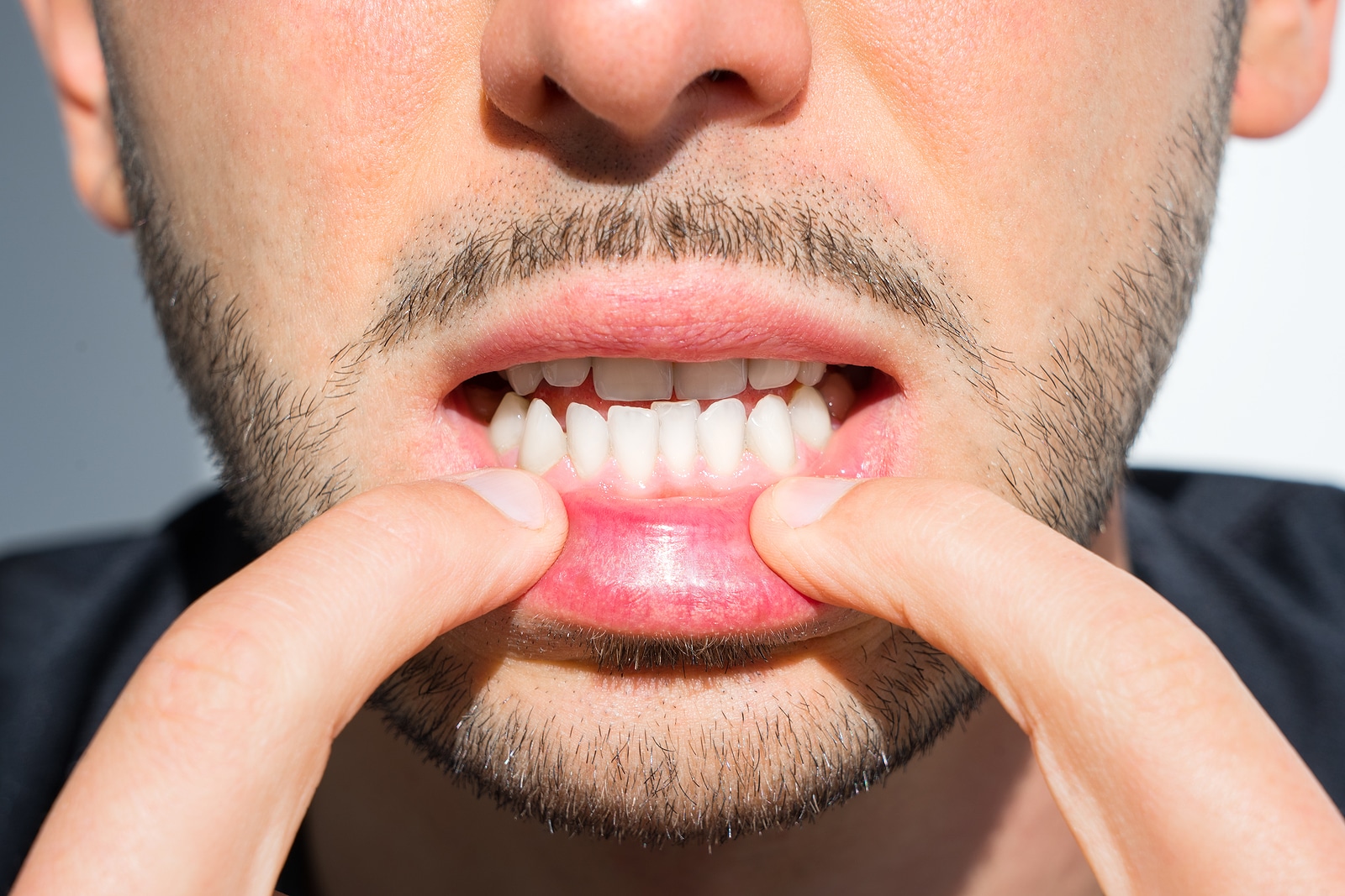 bigstock-Young-Man-Crooked-Teeth-Reaso-403620719 bigstock Young Man Crooked Teeth Reaso 403620719