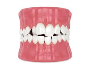 bigstock-d-Render-Of-Jaw-With-Abnormal-432160292-300x225 bigstock d Render Of Jaw With Abnormal 432160292 300x225