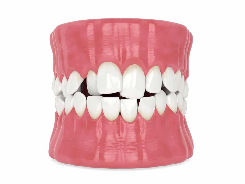 bigstock d Render Of Jaw With Abnormal 432160292