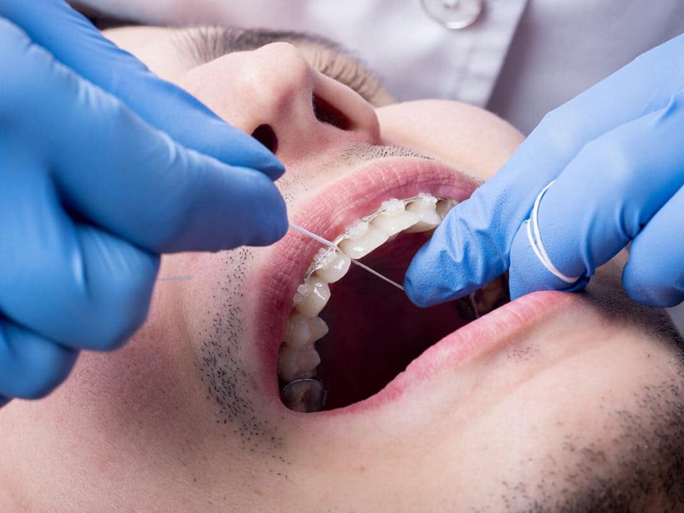 flossing with braces
