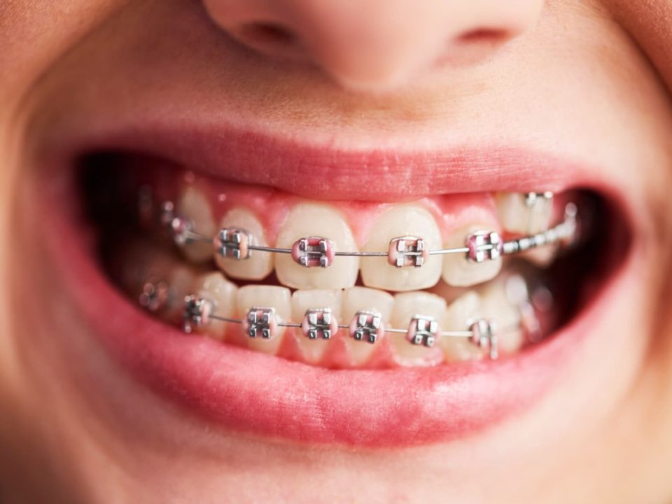 insurance cover braces in johns creek