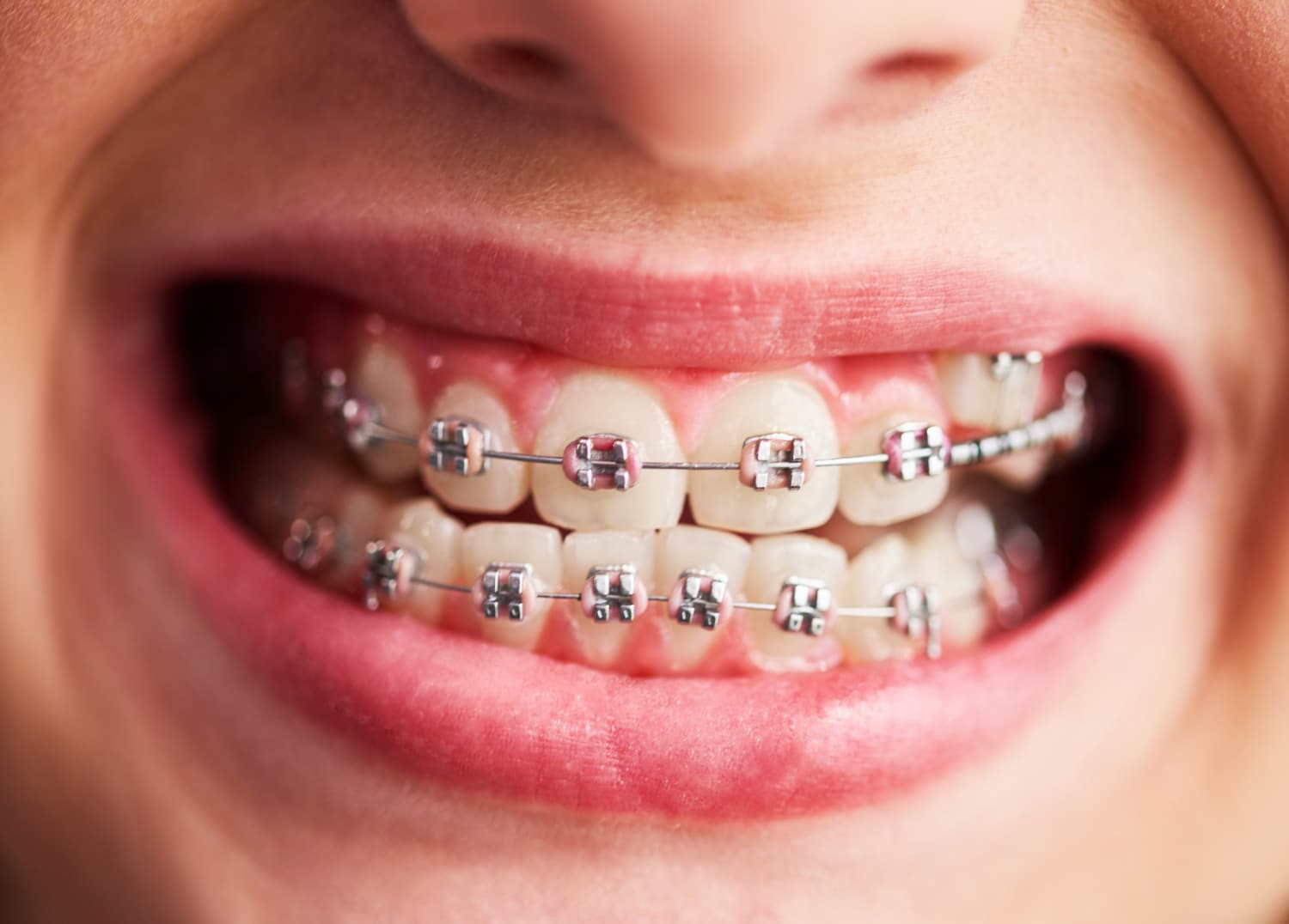 insurance cover braces in johns creek