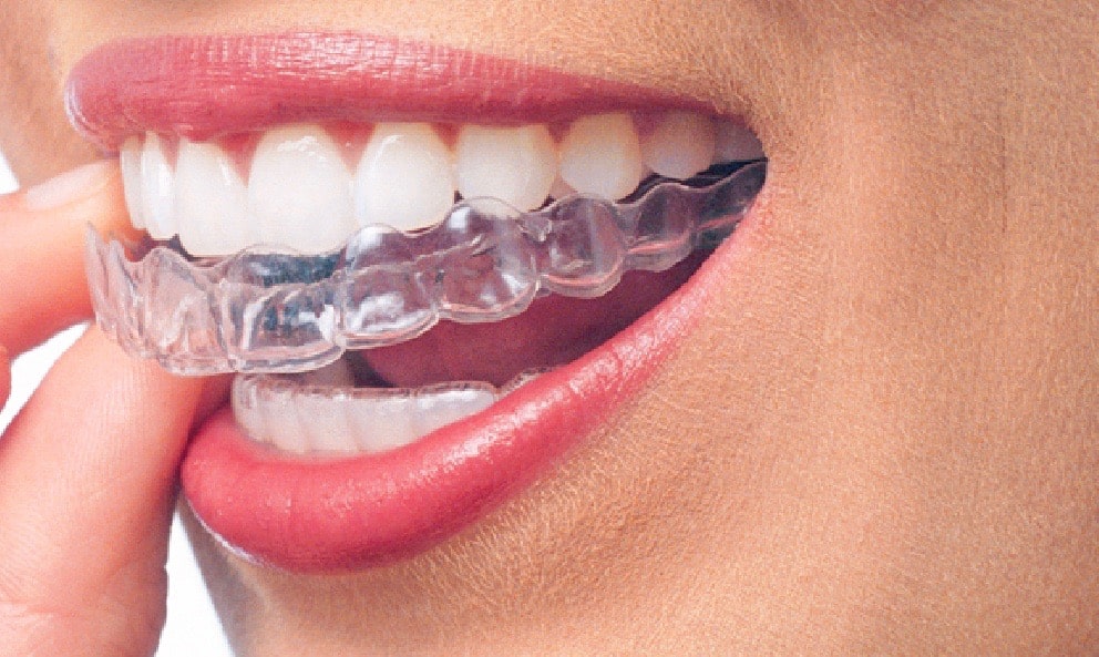invisalign for teens suwanee 1